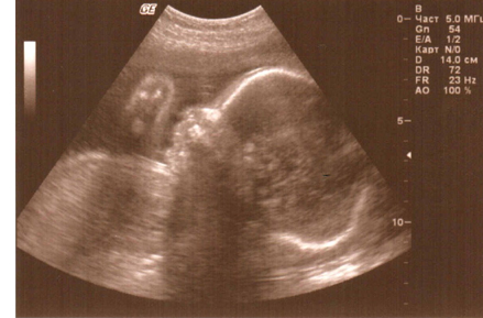 УЗИ на 27 недели бременности