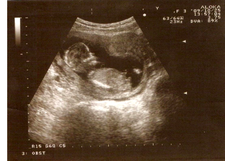 15 неделя беременности